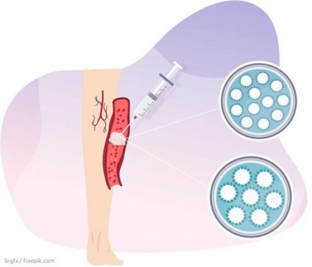 Esquema de una vena varicosa en la que se inyecta espuma esclerosante (UGR) Esquema de una vena varicosa en la que se inyecta espuma esclerosante (UGR)