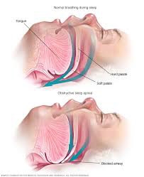 Apnea del sueño (MAYOCLINIC) Apnea del sueño (MAYOCLINIC)
