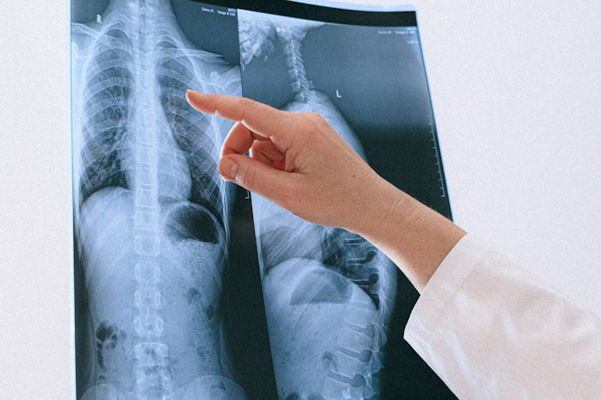 Radiografía de pulmón (IBS GRANADA)