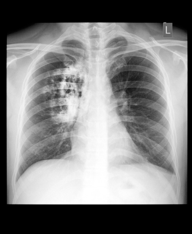 Cáncer de pulmón (MEDINE PLUS)