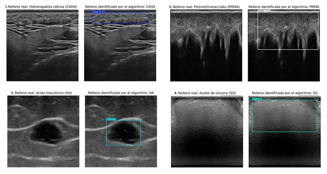 Ecografías que muestran rellenos estéticos identificados por un especialista (izquierda) y las regiones detectadas por el algoritmo (derecha). En los cuatro casos, el algoritmo acertó en clasificar y delimitar el área de cada relleno. (UGR)